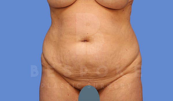 Tummy Tuck Before & After Gallery - Patient 5776275 - Image 1