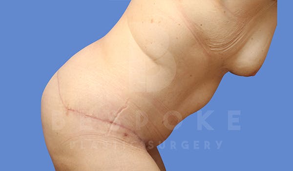 Tummy Tuck Before & After Gallery - Patient 5776274 - Image 4