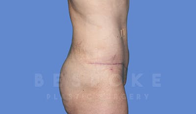 Tummy Tuck Before & After Gallery - Patient 5776273 - Image 6