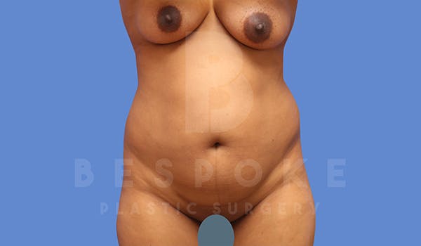 Tummy Tuck Before & After Gallery - Patient 5776276 - Image 1