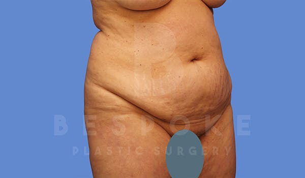 Tummy Tuck Before & After Gallery - Patient 5776275 - Image 3