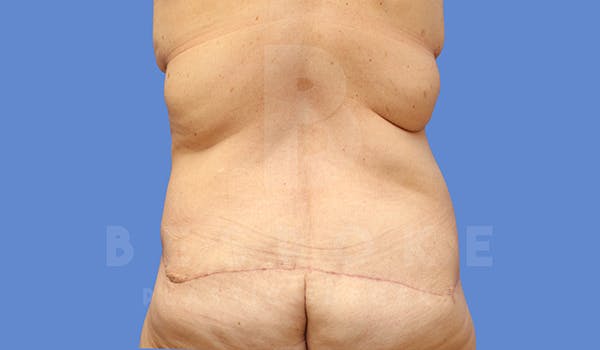 Tummy Tuck Before & After Gallery - Patient 5776274 - Image 6