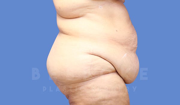 Extended Tummy Tuck Before & After Gallery - Patient 282858 - Image 7