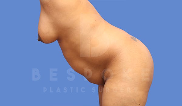 Tummy Tuck Before & After Gallery - Patient 5776276 - Image 3