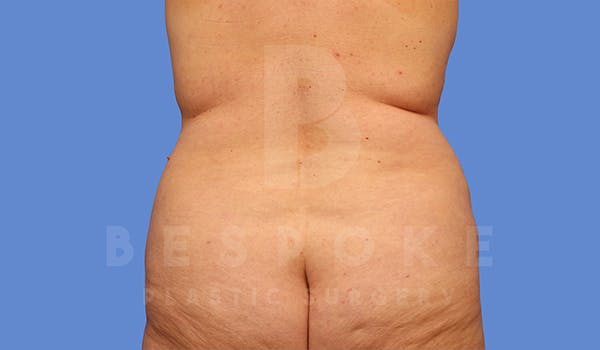 Tummy Tuck Before & After Gallery - Patient 5776275 - Image 5