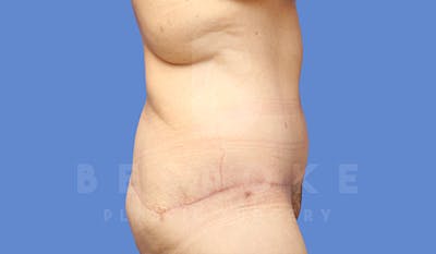 Tummy Tuck Gallery - Patient 5776274 - Image 8