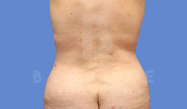 Tummy Tuck Before & After Gallery - Patient 5776275 - Image 6