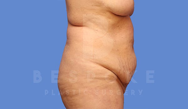 Tummy Tuck Before & After Gallery - Patient 5776275 - Image 7