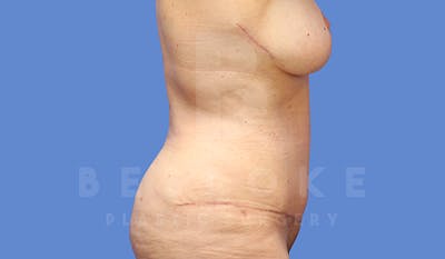 Tummy Tuck Before & After Gallery - Patient 5776275 - Image 8