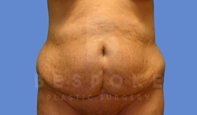 Tummy Tuck Before & After Gallery - Patient 5776277 - Image 1