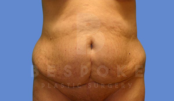 Tummy Tuck Before & After Gallery - Patient 5776277 - Image 1