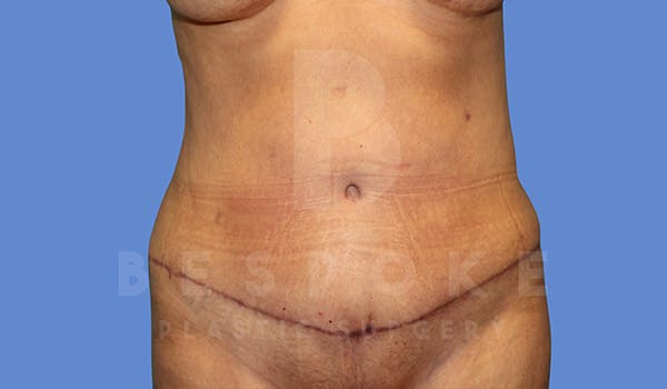 Tummy Tuck Before & After Gallery - Patient 5776277 - Image 2
