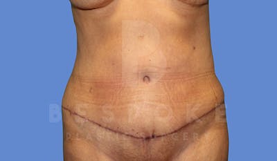 Tummy Tuck Gallery - Patient 5776277 - Image 2