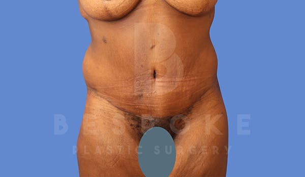 Extended Tummy Tuck Before & After Gallery - Patient 343691 - Image 2