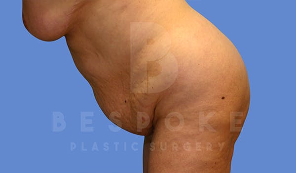Tummy Tuck Before & After Gallery - Patient 5776277 - Image 5