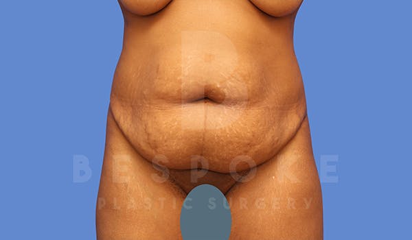Tummy Tuck Before & After Gallery - Patient 5776279 - Image 1