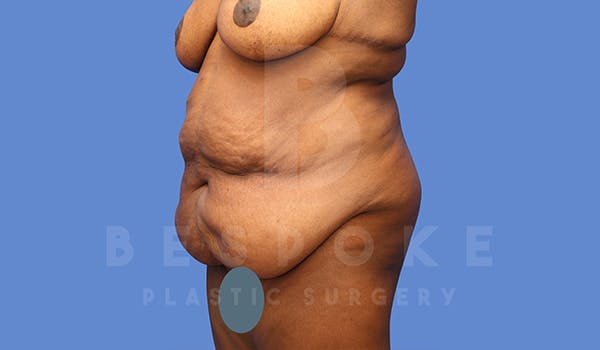 Extended Tummy Tuck Before & After Gallery - Patient 343691 - Image 5