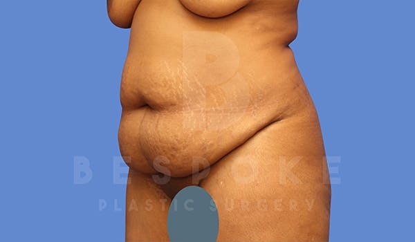 Tummy Tuck Before & After Gallery - Patient 5776279 - Image 3