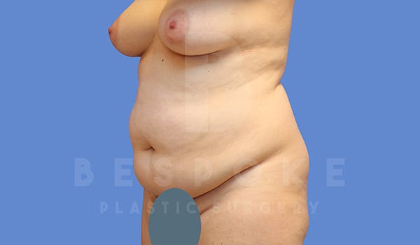 Tummy Tuck Before & After Gallery - Patient 5776280 - Image 1
