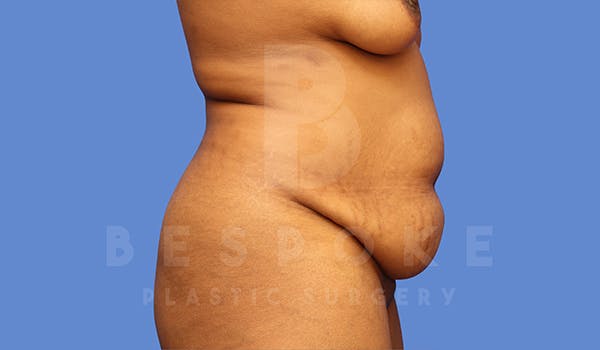 Tummy Tuck Gallery - Patient 5776279 - Image 5