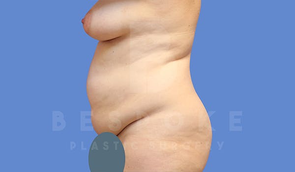Tummy Tuck Before & After Gallery - Patient 5776280 - Image 3