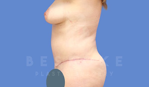 Tummy Tuck Before & After Gallery - Patient 5776280 - Image 4