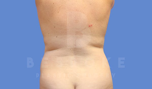 Tummy Tuck Before & After Gallery - Patient 5776280 - Image 5