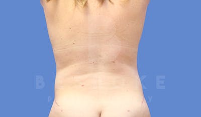 Tummy Tuck Before & After Gallery - Patient 5776280 - Image 6