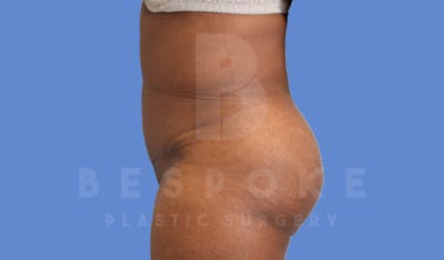 Brazilian Butt Lift Before & After Gallery - Patient 143575165 - Image 2
