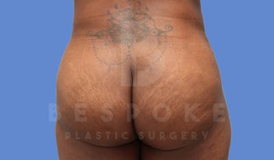 Brazilian Butt Lift Before & After Gallery - Patient 143575165 - Image 4