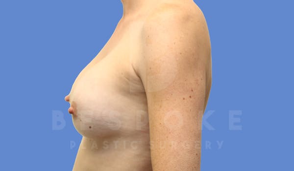 Breast Revision Surgery Before & After Gallery - Patient 143575180 - Image 5