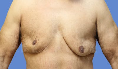 Gynecomastia Before & After Gallery - Patient 143575202 - Image 1