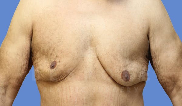 Gynecomastia Before & After Gallery - Patient 143575202 - Image 1