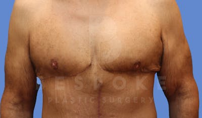 Gynecomastia Before & After Gallery - Patient 143575202 - Image 2