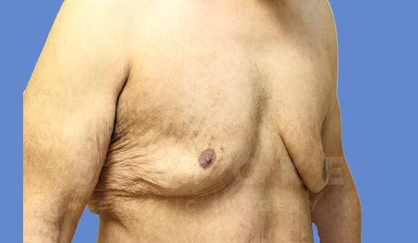 Gynecomastia Before & After Gallery - Patient 143575202 - Image 3
