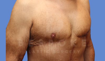 Gynecomastia Before & After Gallery - Patient 143575202 - Image 4