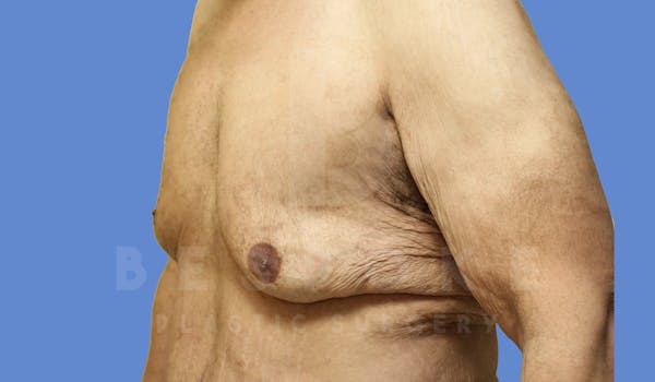 Gynecomastia Before & After Gallery - Patient 143575202 - Image 5
