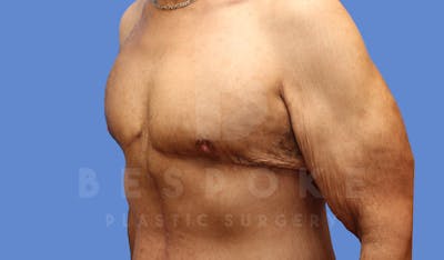 Gynecomastia Before & After Gallery - Patient 143575202 - Image 6