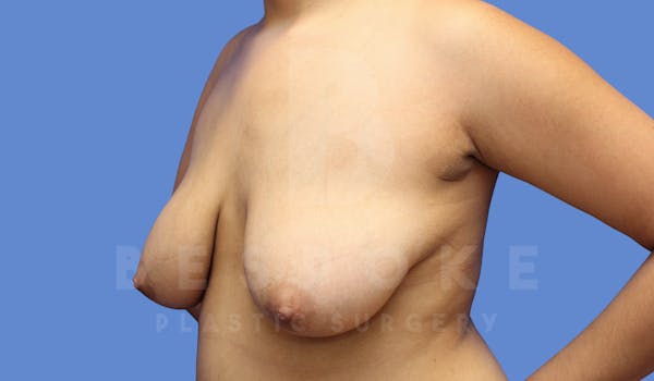 Breast Lift With Implants Before & After Gallery - Patient 143675508 - Image 5