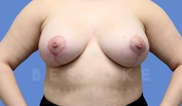 Breast Lift With Implants Before & After Gallery - Patient 143675507 - Image 2