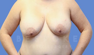 Breast Lift With Implants Before & After Gallery - Patient 143675506 - Image 1