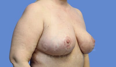 Breast Reduction Before & After Gallery - Patient 143675552 - Image 4
