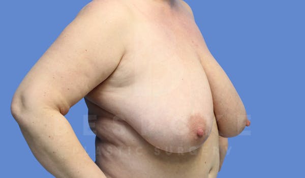 Breast Reduction Before & After Gallery - Patient 143675552 - Image 3