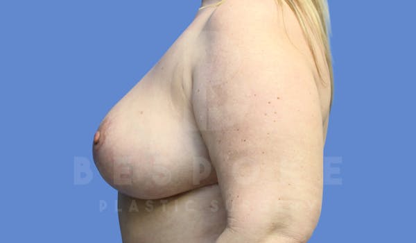 Breast Reduction Before & After Gallery - Patient 143675552 - Image 6