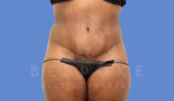 Tummy Tuck Before & After Gallery - Patient 143675813 - Image 2