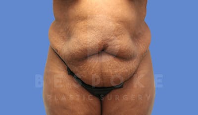 Tummy Tuck Before & After Gallery - Patient 143675813 - Image 1