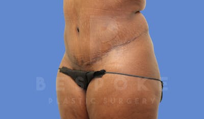 Tummy Tuck Before & After Gallery - Patient 143675813 - Image 4