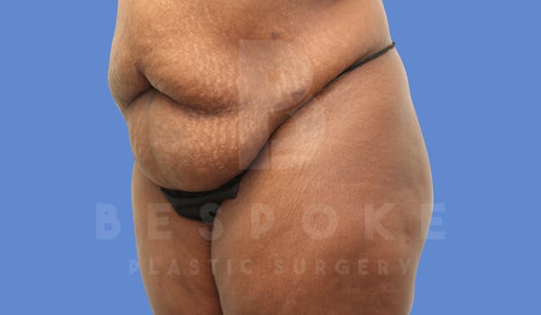 Tummy Tuck Before & After Gallery - Patient 143675813 - Image 3