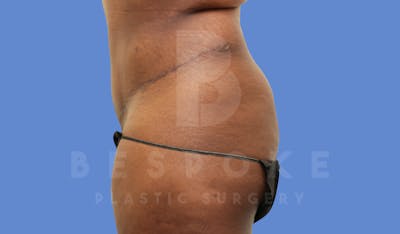 Tummy Tuck Before & After Gallery - Patient 143675813 - Image 6