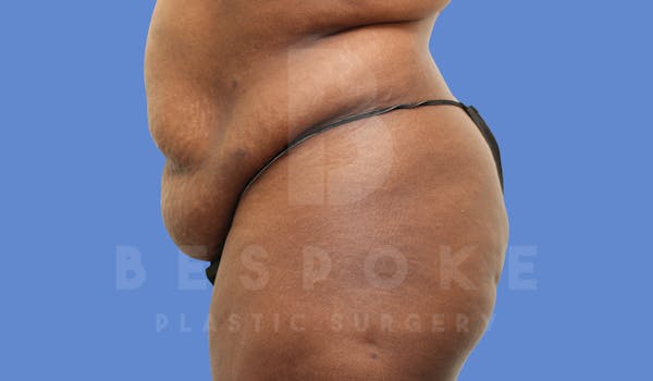 Tummy Tuck Before & After Gallery - Patient 143675813 - Image 5